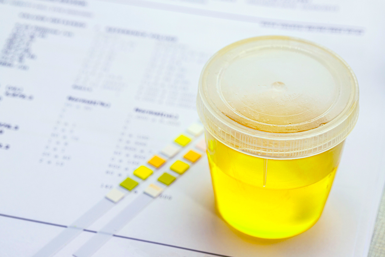 urine vial in laboratory toxicology or routine examination