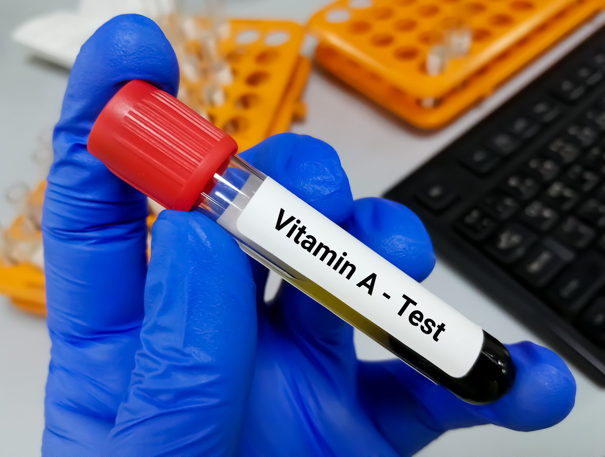 Blood sample for Vitamin A test